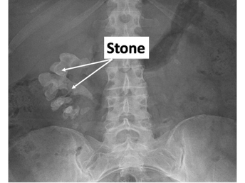 struvite stone x ray