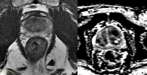 Normal Prostrate Mri MRI Prostate - Urology Waikato