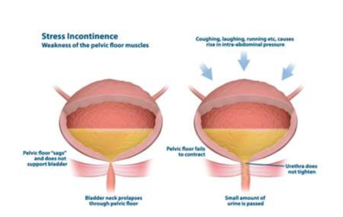 Urinary Incontinence in Women: About Your Pregnancy and Incontinence